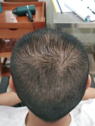 -碧莲盛·不剃发植发