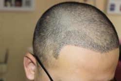 -大麦微针植发丨全国连锁