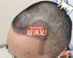 -大麦微针植发全国连锁