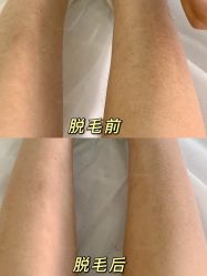 -HEYAN荷妍专业脱毛连锁机构