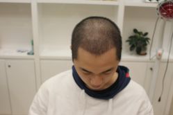 点击看大图 -大麦微针植发丨全国连锁