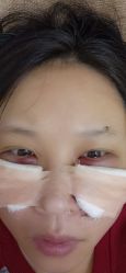 点击看大图 体验后-Yestar宁波艺星整形医院