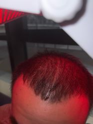 -碧莲盛·不剃发植发