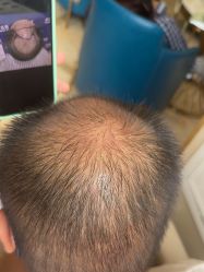 -碧莲盛·不剃发植发