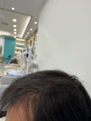 -碧莲盛·不剃发植发