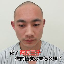 -碧莲盛·不剃发植发