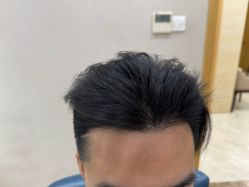 体验后-大麦微针植发丨全国连锁