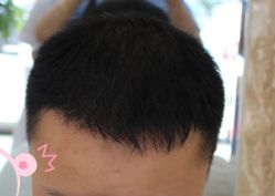 -大麦微针植发丨全国连锁