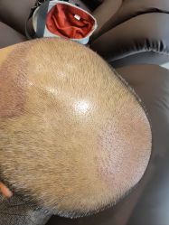 -碧莲盛·不剃发植发