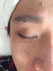 -爱莎扁平疣·汗管瘤·斑痣中心