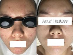 -美肤盾祛痘·问题肌头疗管理中心