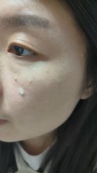 -北京美痣堂古方祛痣斑疣瘊
