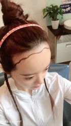 -大麦微针植发丨全国连锁