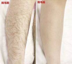 -HEYAN荷妍专业脱毛连锁机构