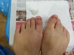 android_upload_pic-EPAI·灰指甲·甲沟炎·嵌甲护理