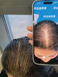 -碧莲盛·不剃发植发