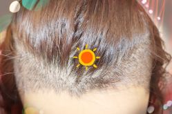 -大麦微针植发全国连锁