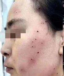 -北京美痣堂古方祛痣斑疣瘊