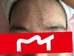 -美丽人生祛斑扁平疣汗管瘤中心