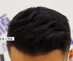 -大麦微针植发全国连锁