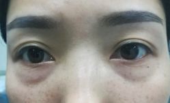 -天津健丽·去眼袋医疗美容机构