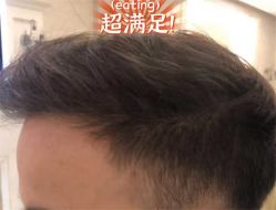 -大麦微针植发全国连锁