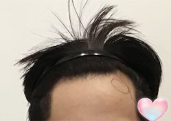 -大麦微针植发全国连锁
