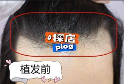 -大麦微针植发全国连锁