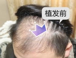 -大麦微针植发全国连锁