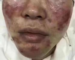 -苗方清颜专业祛痘连锁机构