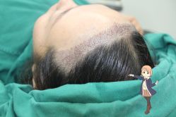 -大麦微针植发丨全国连锁