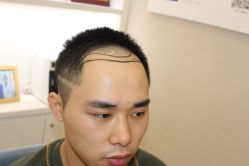 -大麦微针植发丨全国连锁