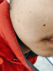 -痣清宫祛斑祛痣连锁店