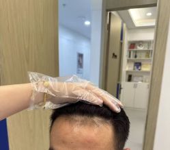 -大麦微针植发全国连锁