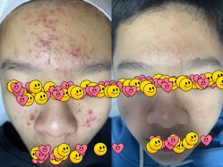 -宜肤清颜专业祛痘问题肌修护