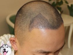 -大麦微针植发丨全国连锁