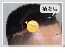 -大麦微针植发全国连锁
