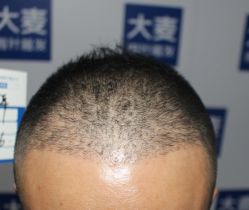 -大麦微针植发丨全国连锁