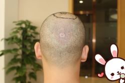 -大麦微针植发丨全国连锁