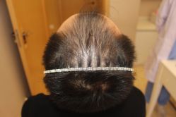 -大麦微针植发丨全国连锁