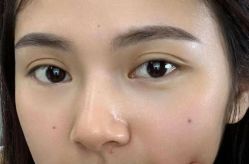 -天津健丽·去眼袋医疗美容机构