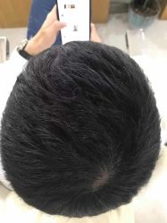 -大麦微针植发全国连锁