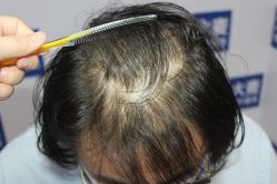 -大麦微针植发丨全国连锁