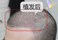 -大麦微针植发全国连锁