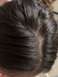 -碧莲盛·不剃发植发