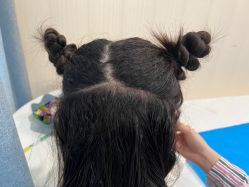 -碧莲盛·不剃发植发