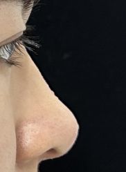 体验后-洁铭新加坡医美