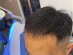 -大麦微针植发全国连锁