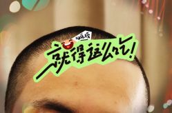 -大麦微针植发全国连锁