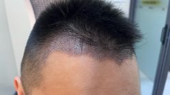 体验后-大麦微针植发全国连锁